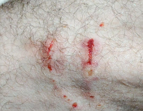 may 6th cat scratch bite knee.png
