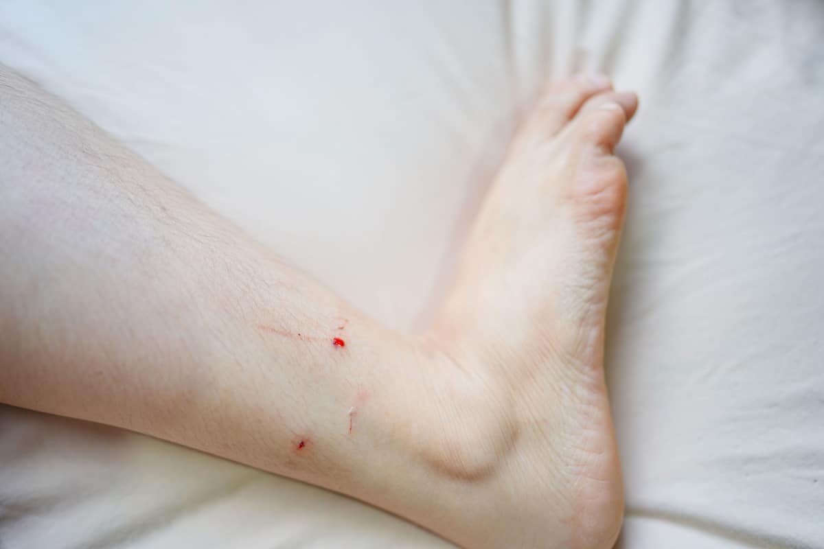 wounds on the ankles, due to being bitten by a cat