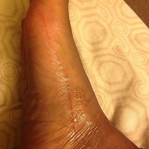 Cat scratched my foot