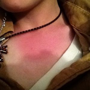 Em I allergic to my neckless?