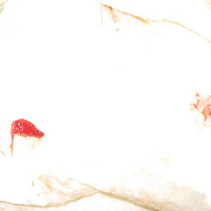 Chestnut:  Urinating Blood Clots - history of Crystals Need ADVICE!!!  thanks